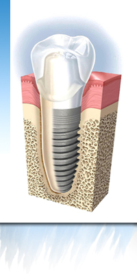 lateral