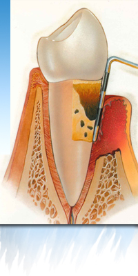 lateral