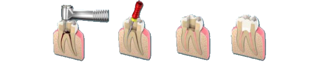 endo